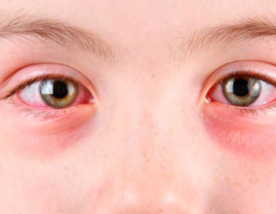 Блефарит у детей: лечение, симптомы, фото