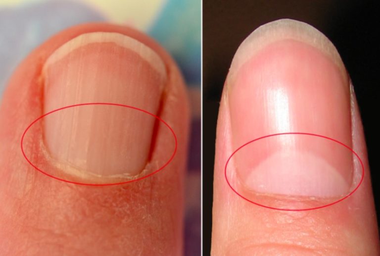 Бугристые ногти и другие типы деформации поверхности больших и остальных пальцев рук и ног у женщин и мужчин: причины, лечение, фото бугорков и иных дефектов