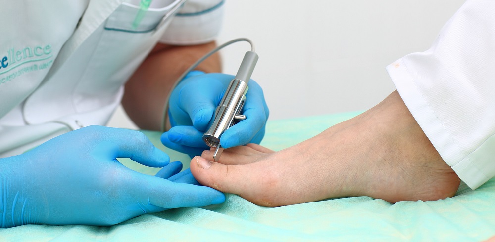 Лечение грибка ногтей лазером в санкт-петербурге. доктор ляшко а.к. тел. (812) 970-25-62