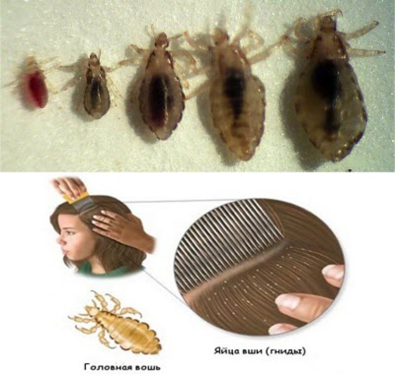 Как избавиться от вшей и гнид – 35 способов борьбы с паразитами