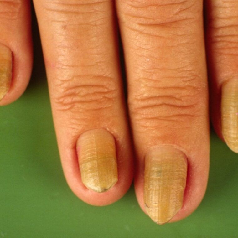 Причины желтизны ногтевой пластины у женщин и мужчин
