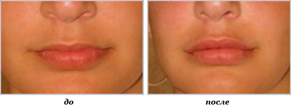 Меняет ли лечение на брекетах лицо и внешность - «стоматология на марата 31»