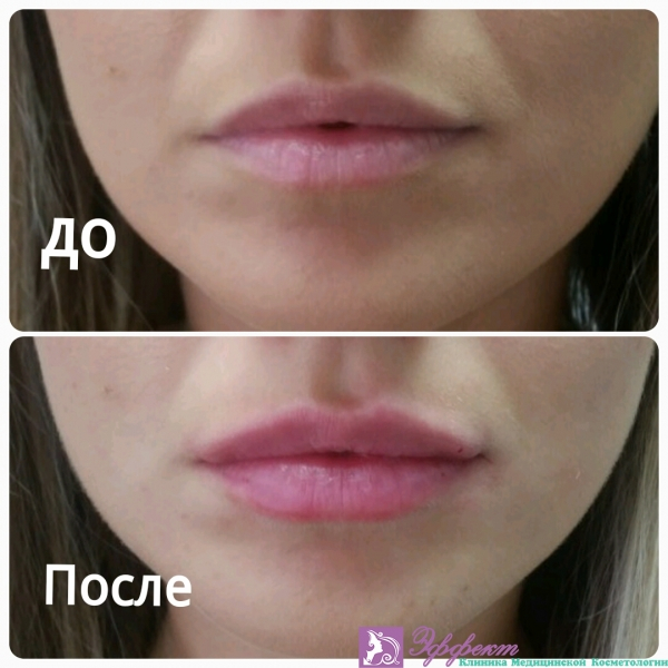 Увеличение губ: препараты, процедура, эффект и противопоказания | портал 1nep.ru