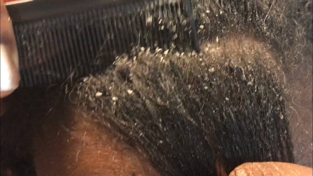 Как отличить чешуйки перхоти от гнид на волосах: размер, локализация, степень дискомфорта. перхоть или вши — как отличить себорею от гнид? признаки и методики распознавания