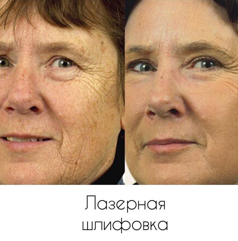 Лазерное излучение в косметологии | портал 1nep.ru