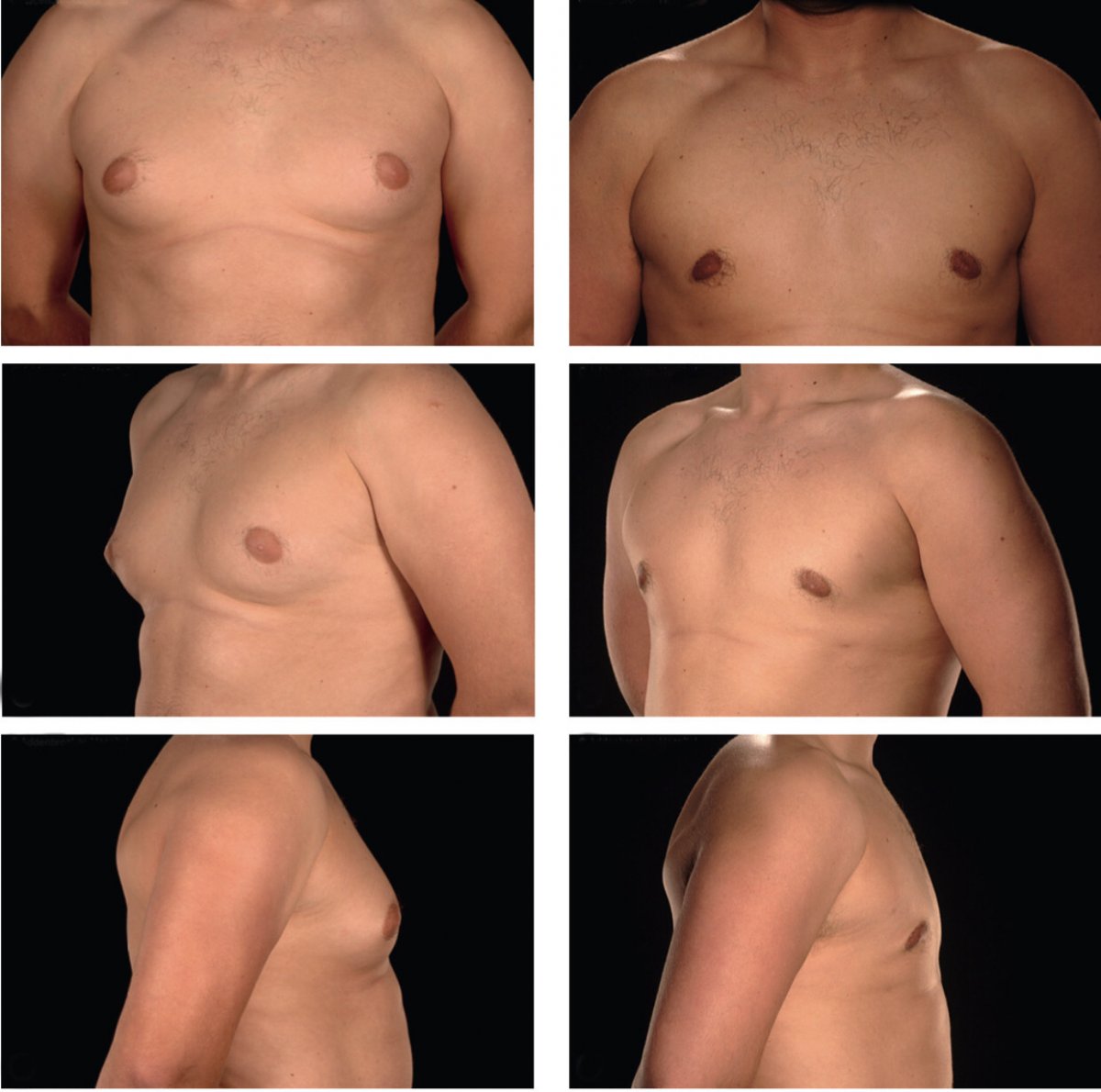 Безоперационная подтяжка грудных желез фото до и после