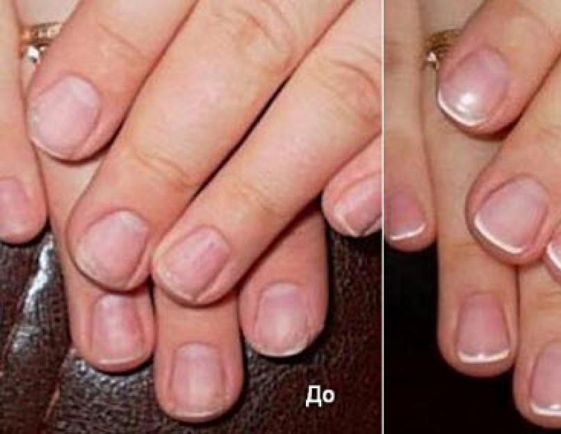 Как восстановить ногти после наращивания?