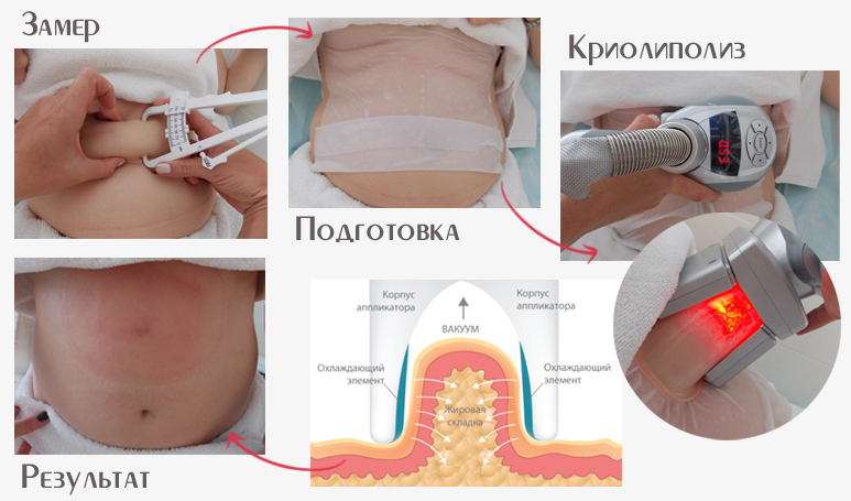Криолиполиз: описание процедуры, противопоказания, фото до и после — online-diagnos.ru