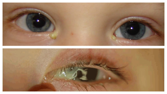 Что такое ленивый глаз у ребенка и как лечится фото пошагово