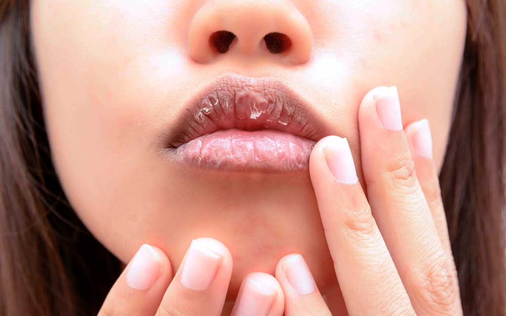 Почему сохнут губы: причины и способы лечения | ceramed
