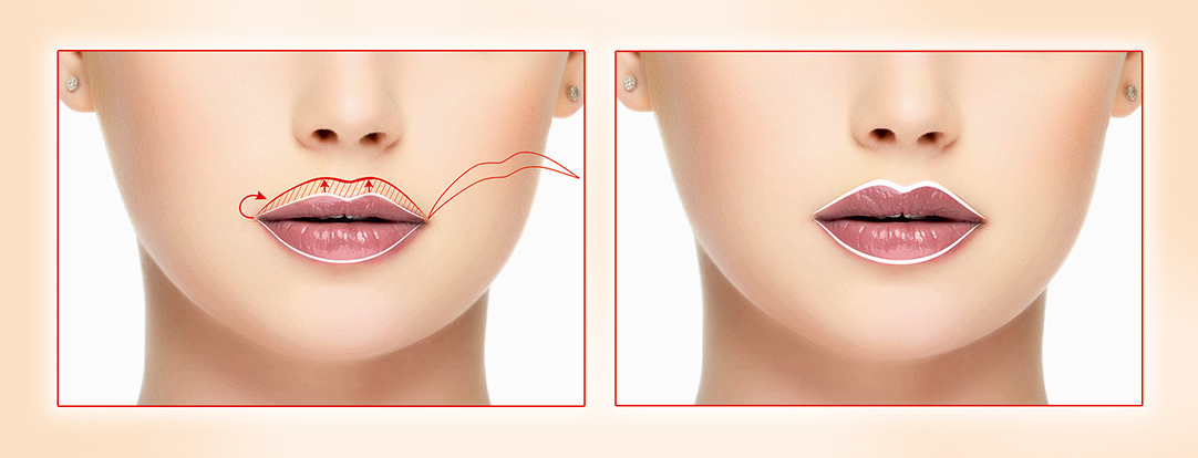 Увеличение и коррекция  губ (хейлопластика).