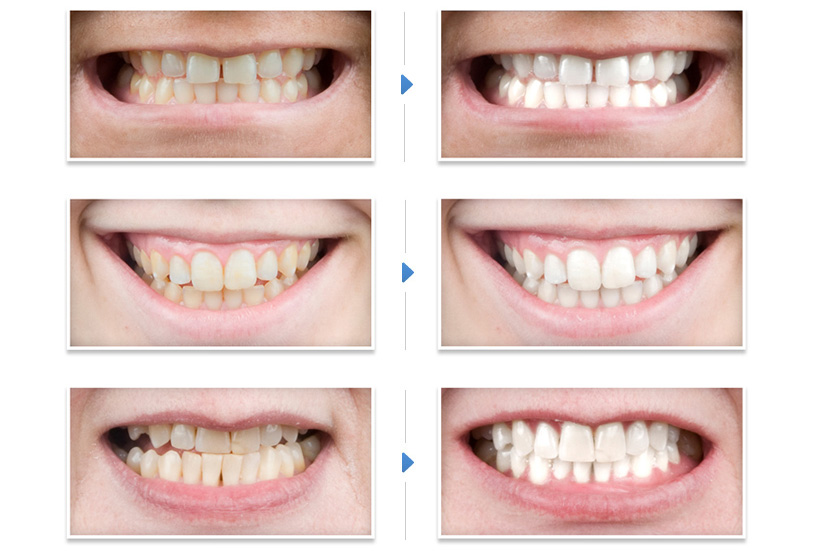 Способы профессионального отбеливания зубов в клиниках
