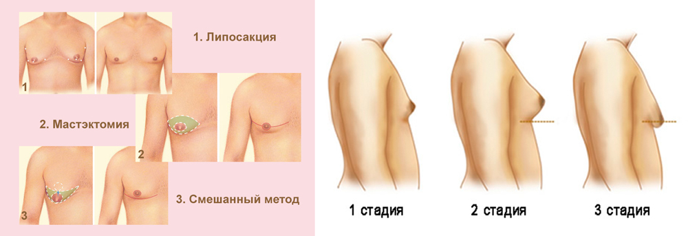 Почему растет второй. Гинекомастия у мужчин 1 стадия. Нормальная грудь. Этапы развития молочных желез. Тубулярность молочных желез.
