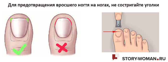 Как вылечить деформацию ногтевой пластины на ноге.