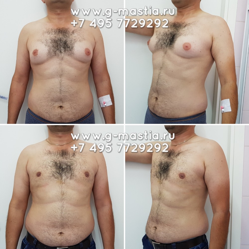 Фото до и после - подтяжка груди т-образная (якорная мастопексия)