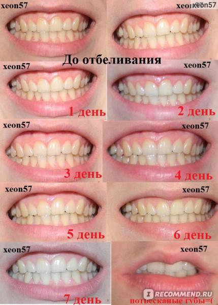 Вред для зубов от самостоятельного отбеливания – статьи стоматологической клиники «доктор мартин»