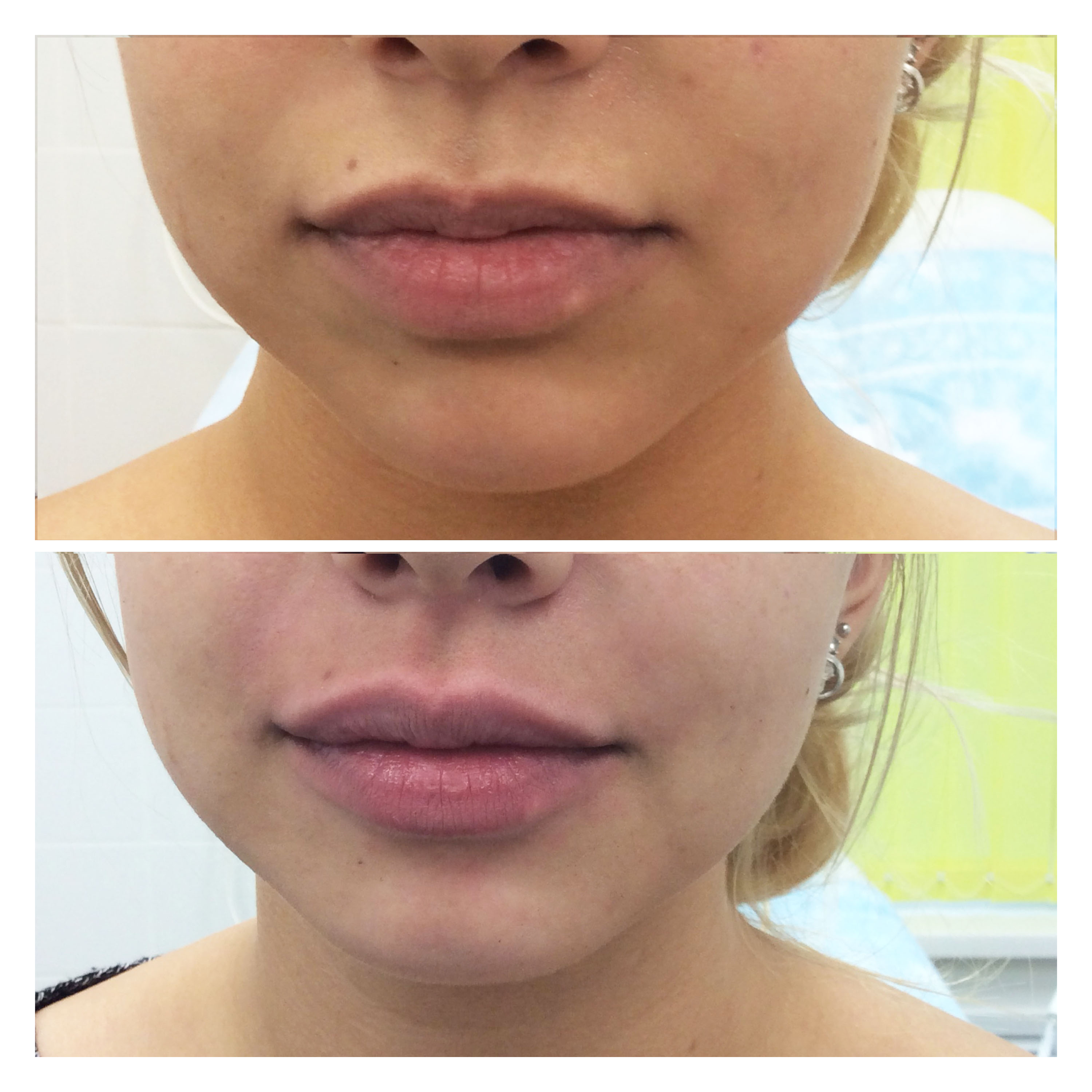 Фото красивых губ после увеличения гиалуроновой кислотой