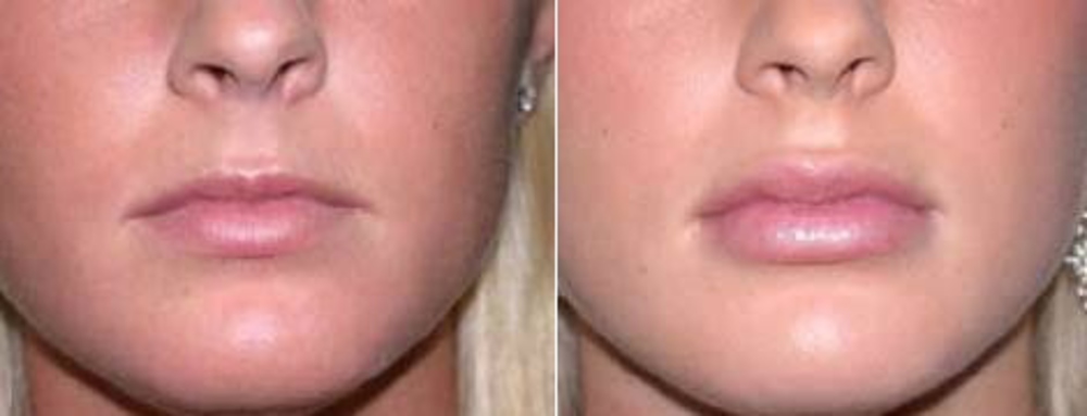 Увеличение губ ботоксом - миф | блог клиники медиэстетик