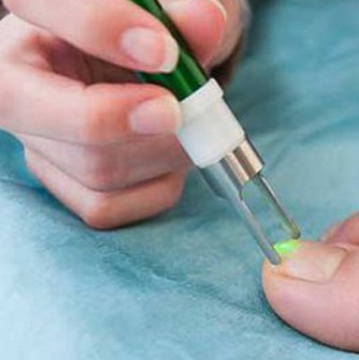 Лазерное лечение грибковых заболеваний ногтей