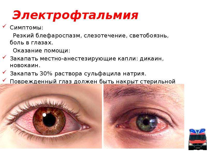 Травмы глаза – лечение и симптомы при кровоизлияниях, ранениях роговицы и других повреждениях