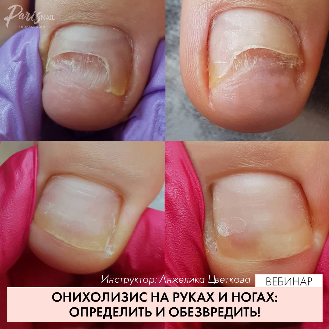 Грибок ногтей