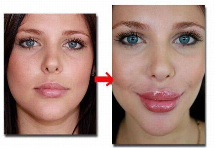 Лабиопластика: о чем нужно знать перед коррекцией половых губ