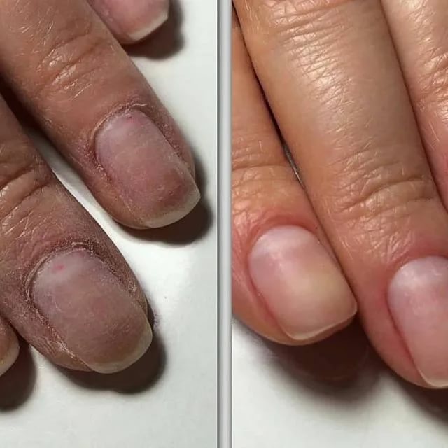 Как восстановить ногти после шеллака