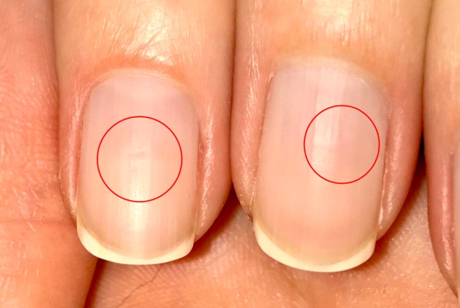 Белые полоски на ногтях: что означают, причины появления и способы лечения