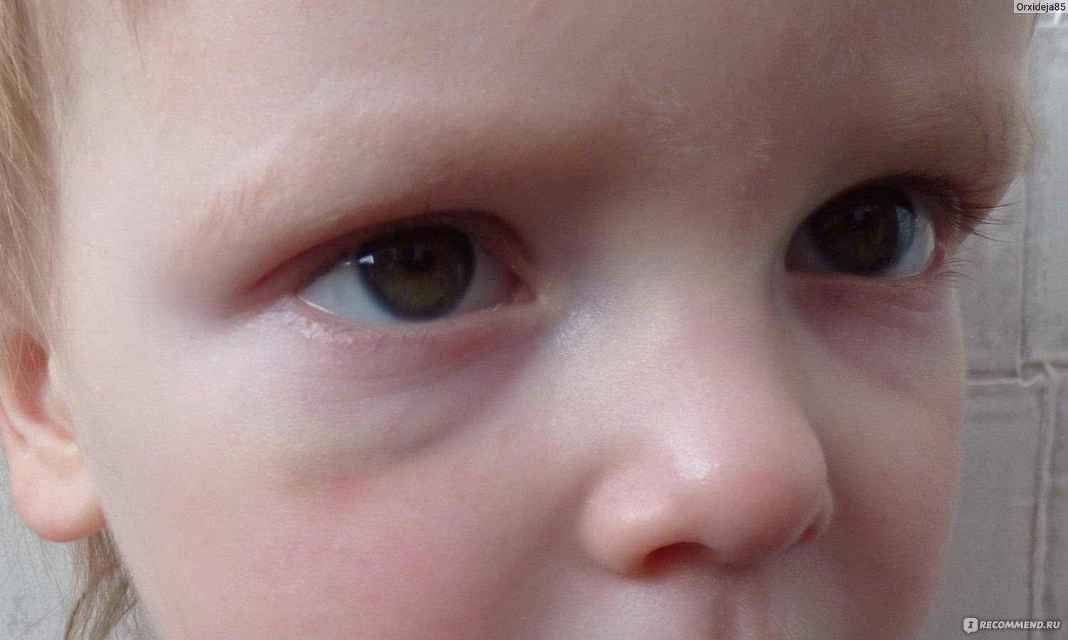 Красные круги под глазами у ребенка: почему может появиться красное пятно и при этом шелушиться, причины и лечение симптома