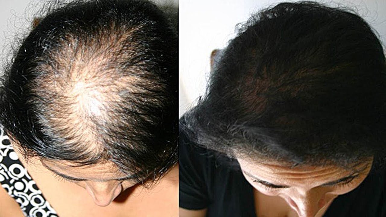 Выпадение волос у женщин: причины и лечение | университетская клиника