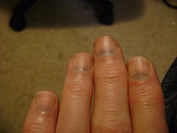 Выпуклые полоски на ногтях рук причины и лечение фото