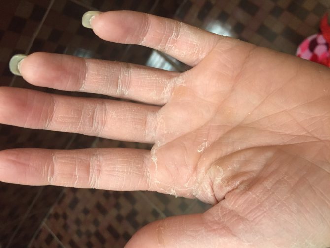 Облазит кожа на пальцах у детей и взрослых: обыкновенное раздражение или опасный недуг? | moninomama.ru