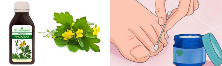 Масло чистотела от грибка ногтей: рецепт приготовления в домашних условиях и спообы применения