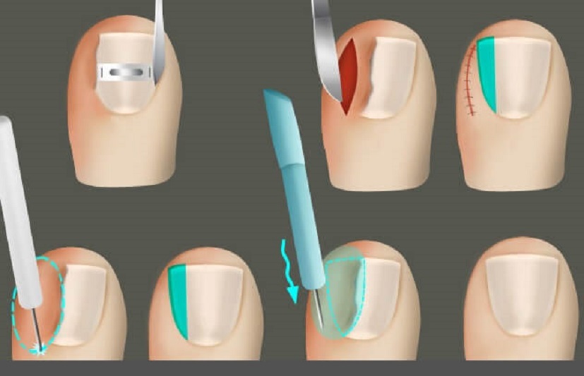 Как правильно подстричь вросший ноготь на ноге в домашних условиях