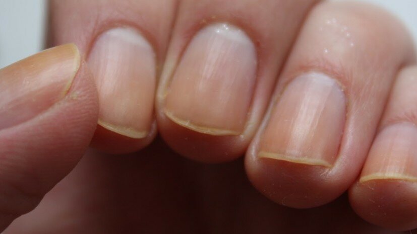 Почему ногти и волосы становятся тонкими