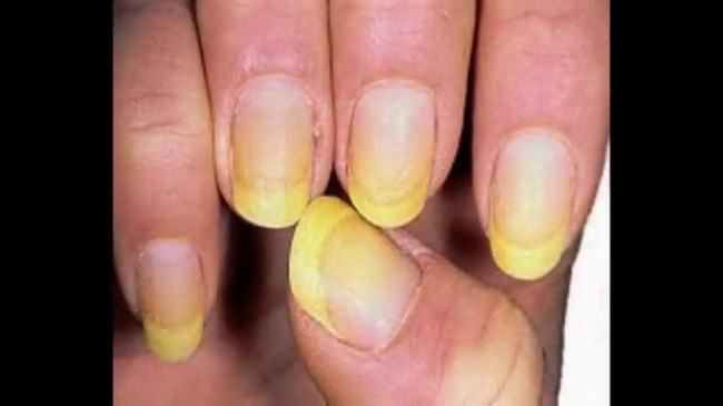 Как быстро вылечить желтые ногти на руках: причины, профилактические меры, способы лечения