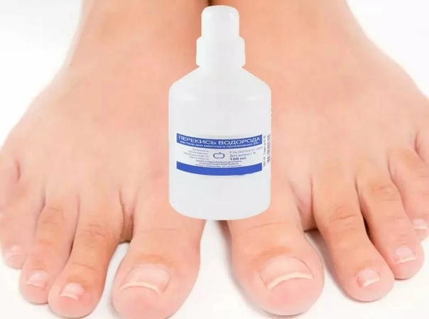 Нетрадиционные способы борьбы с онихомикозом или как лечить грибок ногтей на ногах йодом