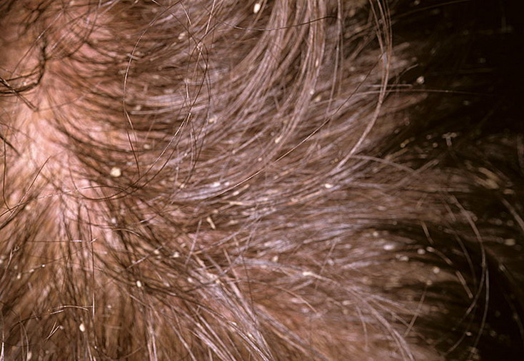 Себорея кожи головы: фото, лечение в домашних условиях