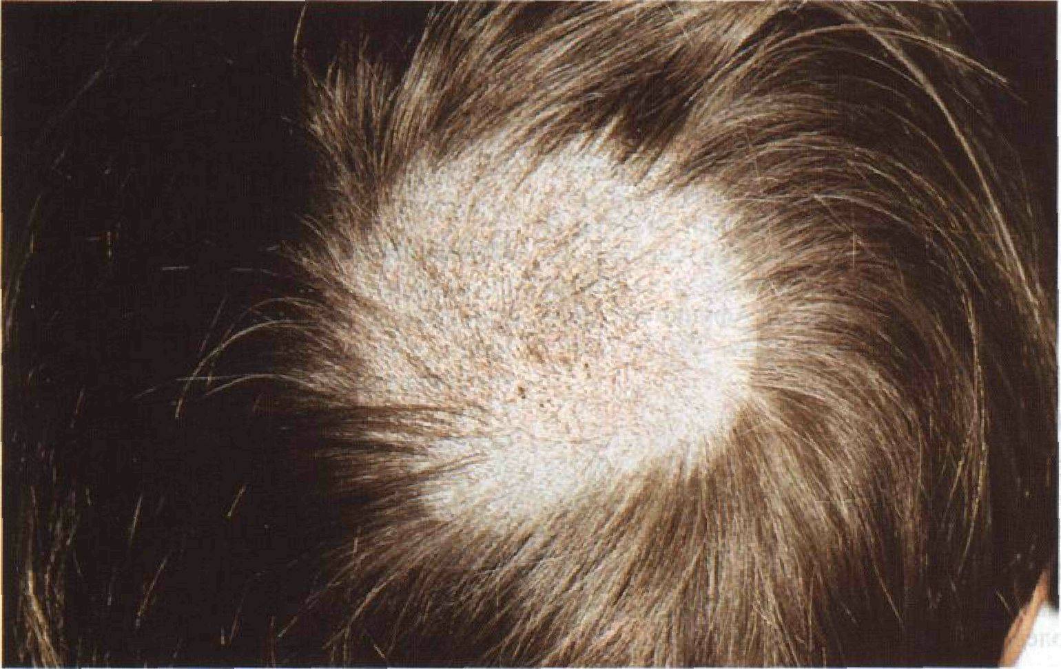 псориаз волосистой части головы фото