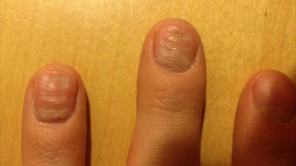 Волнистые ногти на руках и ногах: причины, лечение