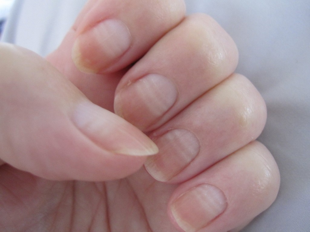Почему ногти на руках волнистые: причины неровной поверхности ногтевой пластины, как её выровнять, профилактики деформации