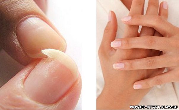 Многослойность им не «к лицу»: что делать, если слоятся ногти? выясняем причины и назначаем лечение