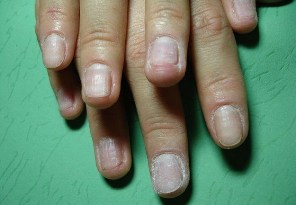 Восстановление ногтей после наращивания: лечение пластин и уход в домашних условиях