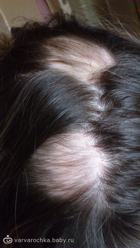 Выпадают волосы после родов: причины, что делать | чистая линия