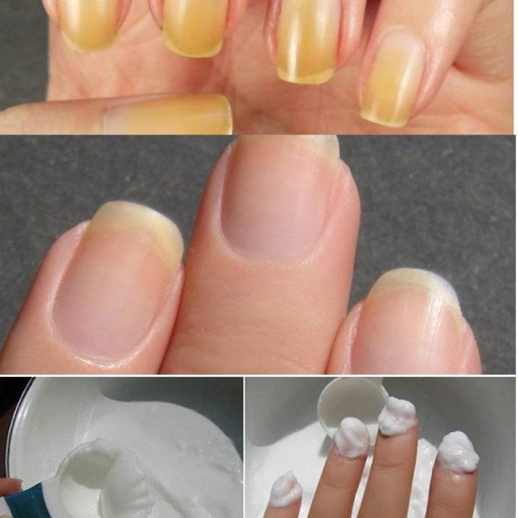 Скорая помощь: выясняем, почему ногти становятся желтыми и, что с этим делать