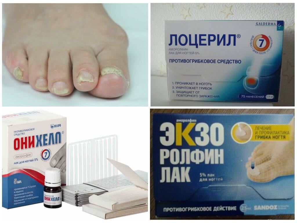 Грибок ногтей: лечение, запущенная форма, симптомы, признаки, средство от грибка ногтей. как выглядит грибок на ногах - форма