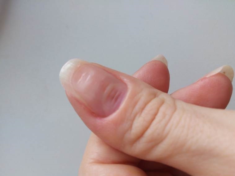 Изменения ногтей во время лечения с применением химиотерапии на основе taxane