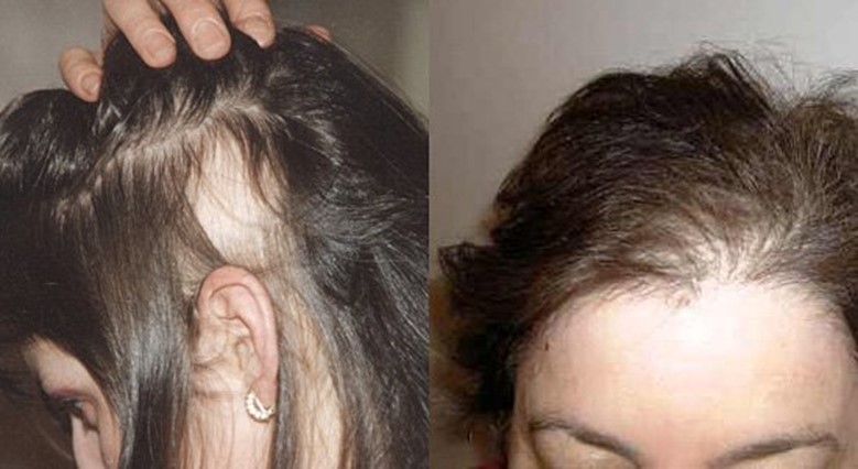 Диффузное выпадение волос * клиника диана в санкт-петербурге