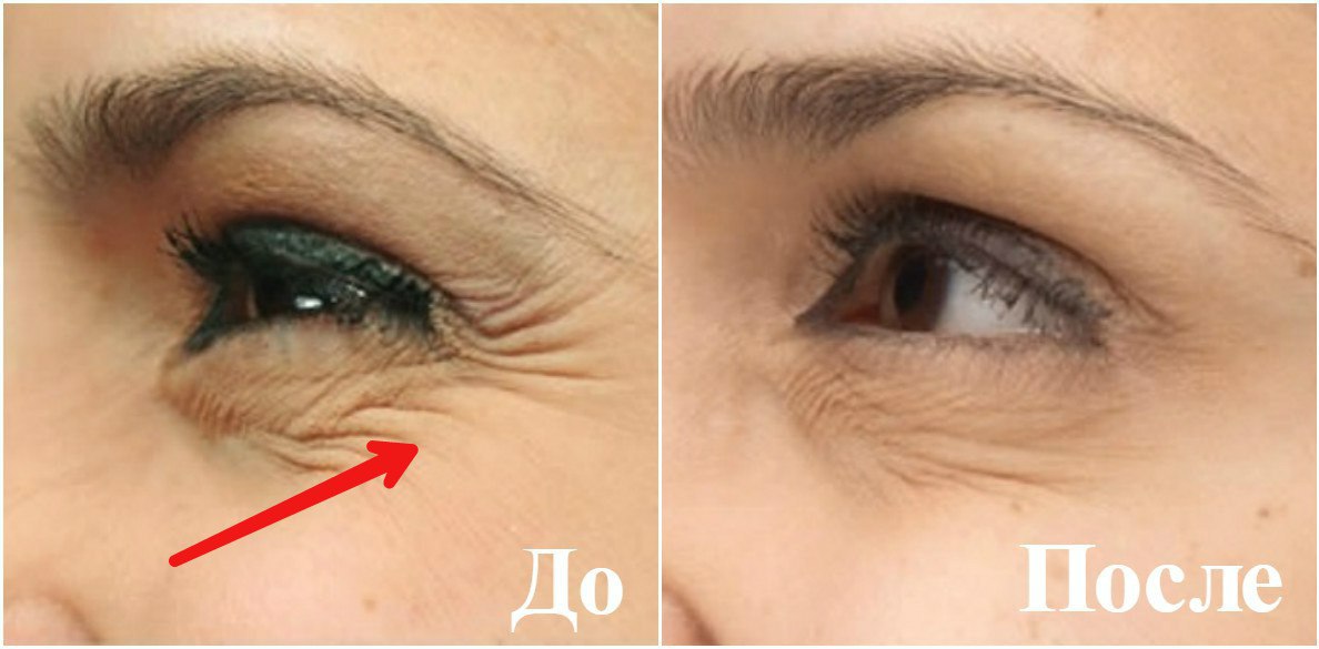 Как уменьшить мимические морщины на лице и вокруг глаз | evolution