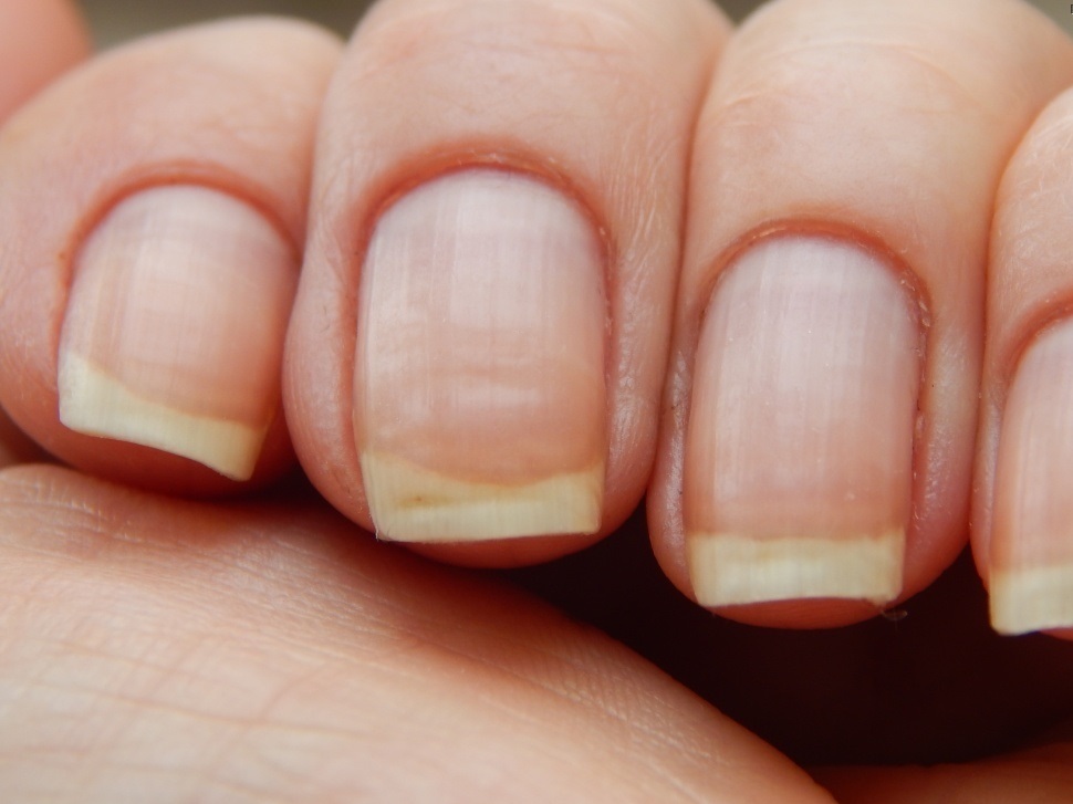 Ребристая поверхность ногтей: почему появляется, как ее восстановить?